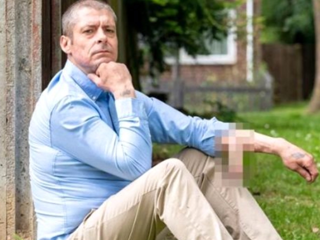 İngiltere'de bir adam 4 yıldır kolunda cinsel organıyla yaşıyor