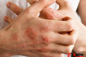 Koronavirüs'ten kaçarken el egzaması nasıl önlenir?